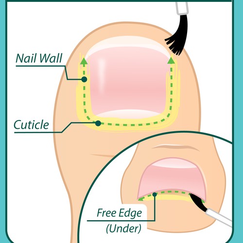 Design Nail Fungus Treatment - Application Diagram por Aerlith