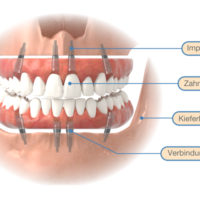 Graphics for implantology