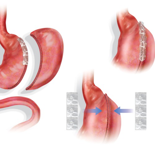 Anatomy artwork with the title 'Gastric Surgery Illustrations'