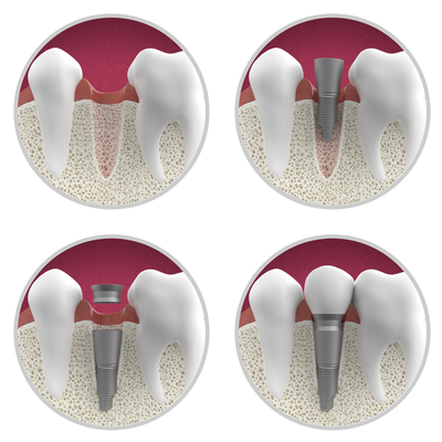Dental implant