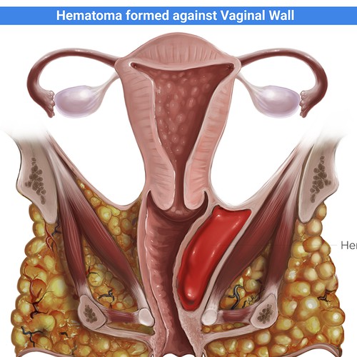 Book illustration artwork with the title 'Hematoma illustration'