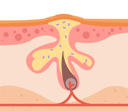 GIF design with the title 'Acne Web Animations'