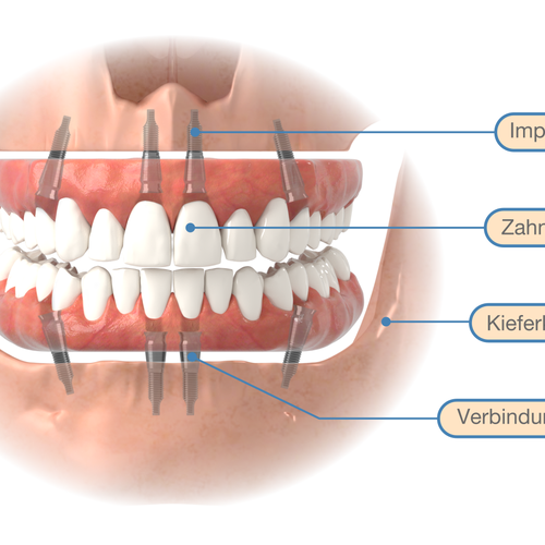 3D illustration with the title 'Graphics for implantology'