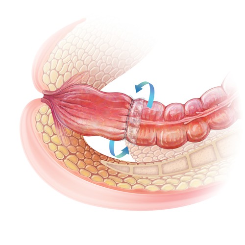 Realistic artwork with the title 'Colon Anastomosis Application Techniques'