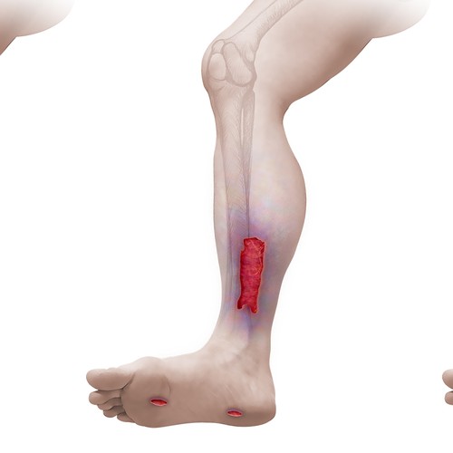 Medical artwork with the title 'Limb Salvage Illustration'