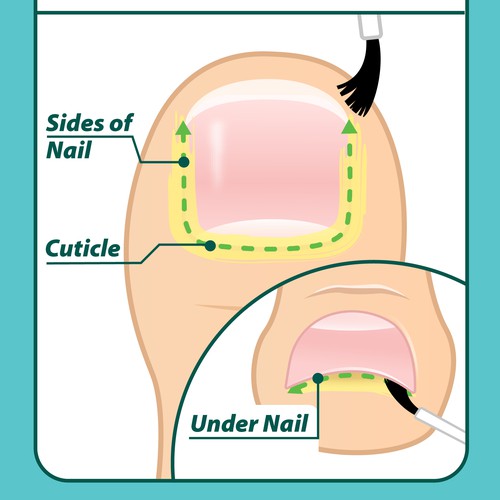 Nail Fungus Treatment - Application Diagram-ontwerp door Aerlith