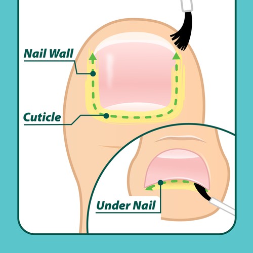 Nail Fungus Treatment - Application Diagram Design by Aerlith