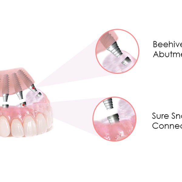 Create an illustration for dental implant bridge