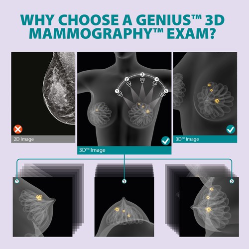 3-D Mammogram Image/Diagram Contest Design by Javad.S