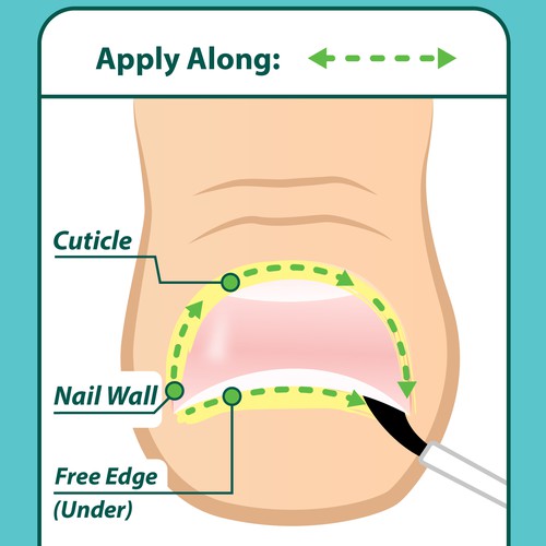 Nail Fungus Treatment - Application Diagram Design by Aerlith