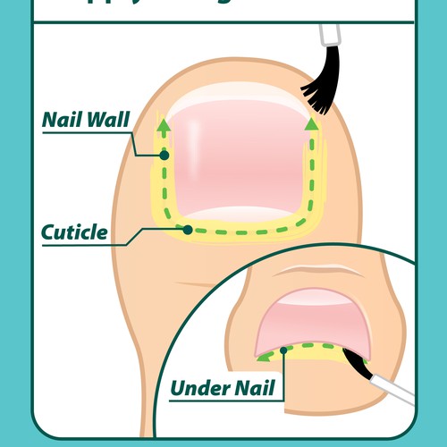 Nail Fungus Treatment - Application Diagram Design by Aerlith